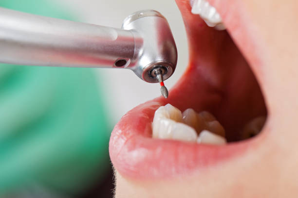 Best Emergency Wisdom Tooth Extraction in Mahomet, IL